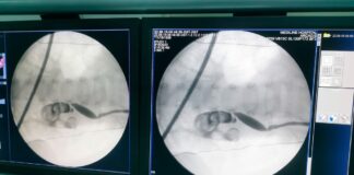 13 aylık bebeğin böbreğinden 5 santimetrelik taş çıktı