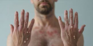 DSÖ Maymun Çiçeği virüsünün adını değiştirecek