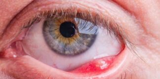 Arpacık nedir? Neden çıkar? Nasıl geçer?