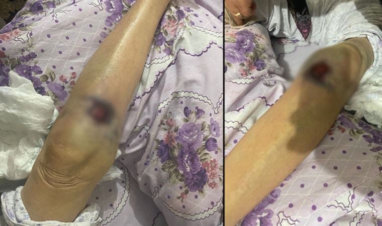 Ankara’da ‘bakıcı’ dehşeti! 91 yaşındaki kadının üzerine sıcak yemek döküldüğü iddia edildi