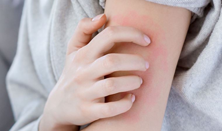 Türkiye’de 5-6 yıldır uyuz vakalarında artış yaşanıyor