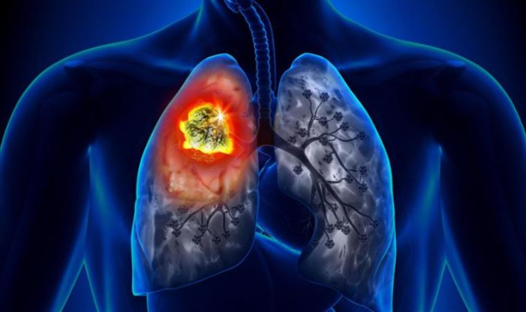 Akciğer kanseri yılda 1.8 milyon ölüme neden oluyor