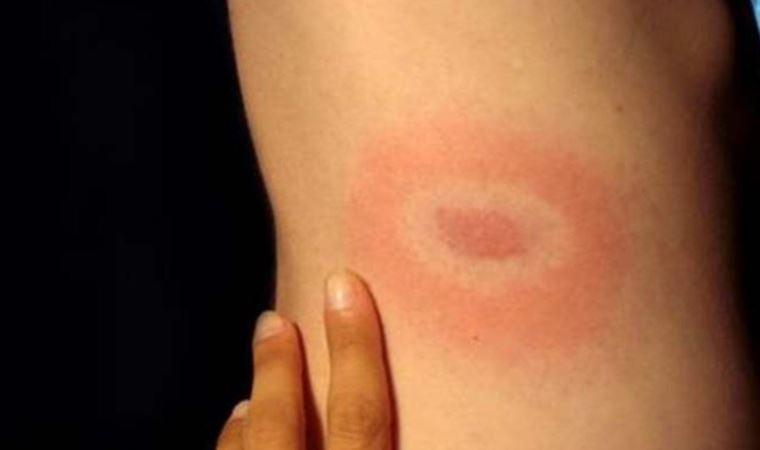 Sessiz pandemi ‘Lyme’: 350 hastalığı taklit ediyor!