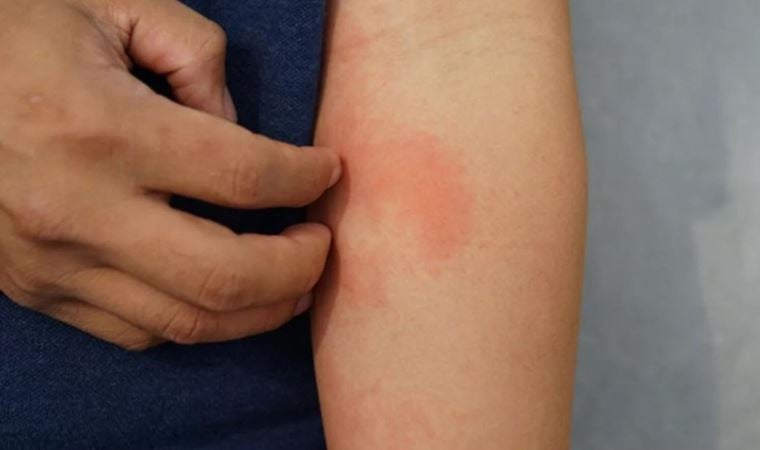 ‘Parfüm kullanımı güneş alerjisini tetikleyebilir’