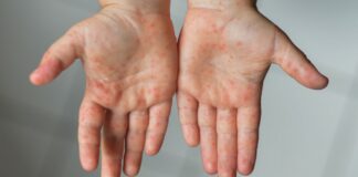 Yunanistan’da kızamık virüsü alarmı